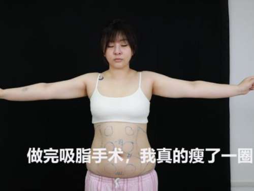 陈叶林吸脂案例分析插图1 陈叶林吸脂案例分析插图1