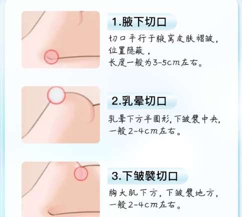 孙大山医生做隆胸怎么样?医生基本信息|案例展示!插图4 孙大山医生做隆胸怎么样?医生基本信息|案例展示!插图4