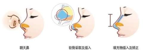 易东风做鼻子怎么样？技术成熟、可以使用多种材料、术中手法微创…插图1