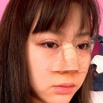 韦小勇鼻子失败修复怎么样?医生简介、坐诊机构、鼻修复案例插图3 韦小勇鼻子失败修复怎么样?医生简介、坐诊机构、鼻修复案例插图3
