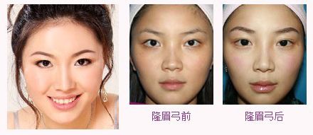 玻尿酸丰眉弓术后需要注意什么?插图