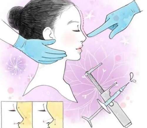 钱玉鑫医生隆鼻怎么样?贵吗?真人前后效果图展示!插图1 钱玉鑫医生隆鼻怎么样?贵吗?真人前后效果图展示!插图1