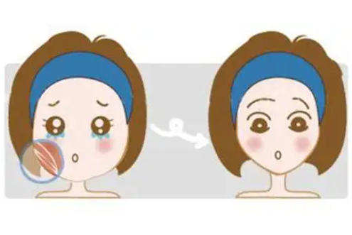 面部吸脂方法有哪些来看看北京新星靓京广医疗的讲解插图 面部吸脂方法有哪些来看看北京新星靓京广医疗的讲解插图