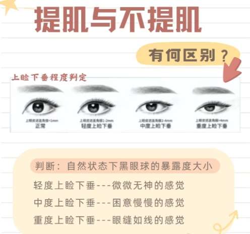 金华双眼皮熊丽!附医生坐诊医院介绍|真实案例分析!插图4 金华双眼皮熊丽!附医生坐诊医院介绍|真实案例分析!插图4