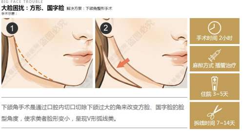 邱立东做改脸型手术怎么样?下颌角4.2w元起、颧骨颧弓4.8w元起,技术在线插图 邱立东做改脸型手术怎么样?下颌角4.2w元起、颧骨颧弓4.8w元起,技术在线插图