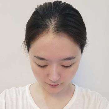 杨长征医生口碑怎么样?技术点评、坐诊机构、双眼皮案例插图3 杨长征医生口碑怎么样?技术点评、坐诊机构、双眼皮案例插图3