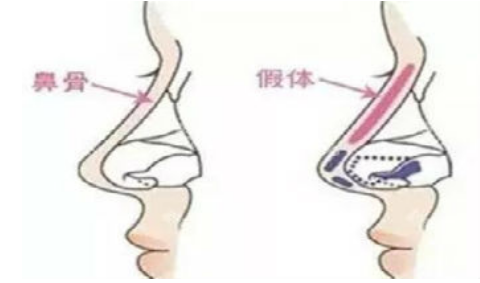 空军特色医学中心整形科好不好隆鼻案例展示~插图1 空军特色医学中心整形科好不好隆鼻案例展示~插图1