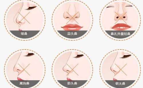 西安国际医学中心医院师俊莉隆鼻子120天恢复案例分析插图1 西安国际医学中心医院师俊莉隆鼻子120天恢复案例分析插图1