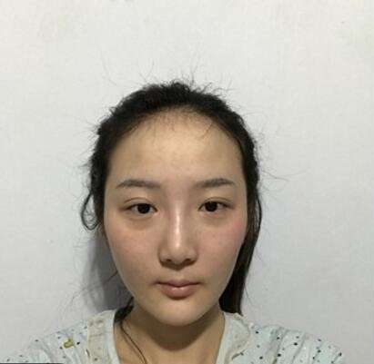 戚昌栋双眼皮修复的好吗?技术怎么样?个人资料、坐诊机构展示插图2 戚昌栋双眼皮修复的好吗?技术怎么样?个人资料、坐诊机构展示插图2