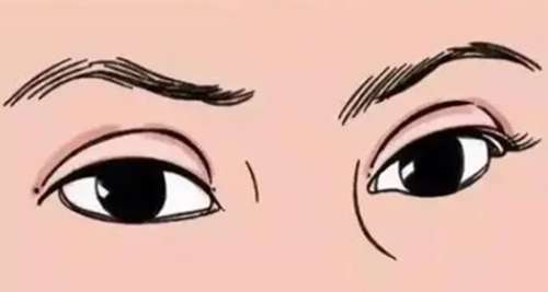 石家庄高玉伟双眼皮怎么样？坐诊医院及双眼皮案例分析插图3