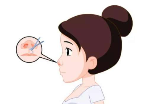 赵延勇医生隆鼻怎么样?稳居2026国内鼻整形前10!附技术细节插图4 赵延勇医生隆鼻怎么样?稳居2026国内鼻整形前10!附技术细节插图4