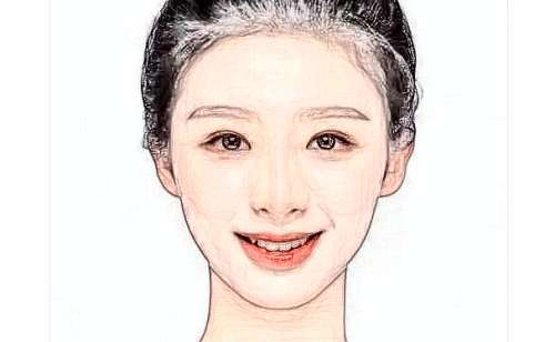 重庆医科大学附属永川医院去眼袋手术术后120天案例分析插图1 重庆医科大学附属永川医院去眼袋手术术后120天案例分析插图1