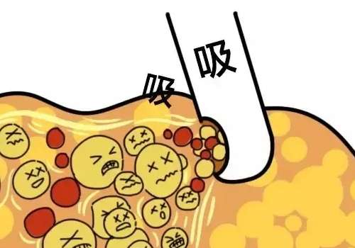 北京纯脂的张春彦吸脂技术好不好?主打精细、自然,价格1w元+起!插图4 北京纯脂的张春彦吸脂技术好不好?主打精细、自然,价格1w元+起!插图4