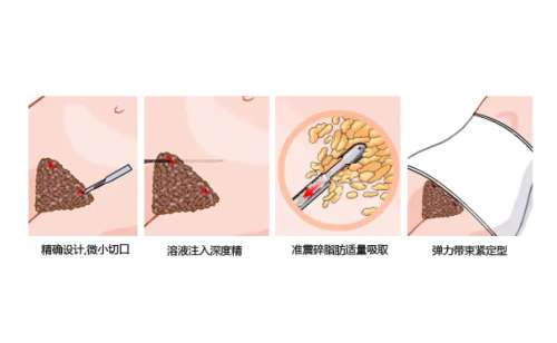 河北省中医院毛俊涛吸脂怎么样?价格表?术后6个月案例分析插图2 河北省中医院毛俊涛吸脂怎么样?价格表?术后6个月案例分析插图2