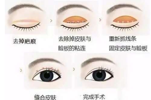 绍兴双眼皮医生蒋燕怎么样?最新医生个人资料信息!插图3 绍兴双眼皮医生蒋燕怎么样?最新医生个人资料信息!插图3