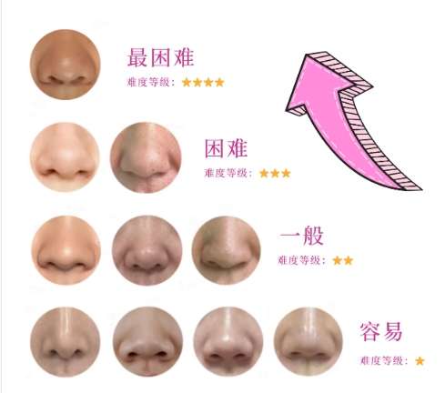 杜良军医生案例图展示!网友隆鼻亲身经历分享!戳进来看插图3 杜良军医生案例图展示!网友隆鼻亲身经历分享!戳进来看插图3
