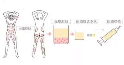 鲁峰医生脂肪填充技术优势：损伤小、性价比高、一人一案…插图2