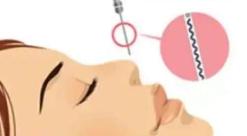 上海九院刘凯医生口碑怎么样?擅长的项目有哪些?鼻部实例插图3 上海九院刘凯医生口碑怎么样?擅长的项目有哪些?鼻部实例插图3