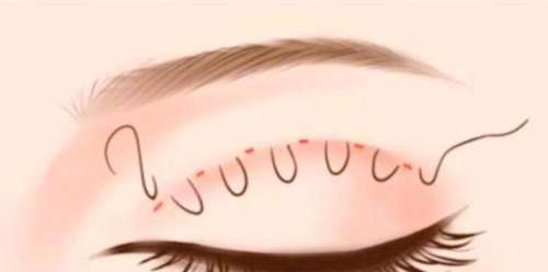 上海有名的双眼皮修复医生名单公布!朱迪、俞哲元凭实力在线!插图4 上海有名的双眼皮修复医生名单公布!朱迪、俞哲元凭实力在线!插图4