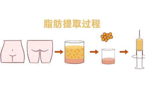 八大处整形医院吴荣薇脂肪填充技术怎么样?费用查询?价格查询插图1 八大处整形医院吴荣薇脂肪填充技术怎么样?费用查询?价格查询插图1