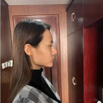 师丽丽双眼皮修复价格多少钱?医生简介、坐诊机构、真人案例插图2 师丽丽双眼皮修复价格多少钱?医生简介、坐诊机构、真人案例插图2