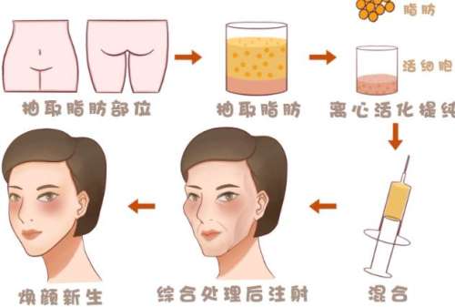 贵阳美贝尔谭主任资质技术如何?脂肪填充案例分析插图2 贵阳美贝尔谭主任资质技术如何?脂肪填充案例分析插图2