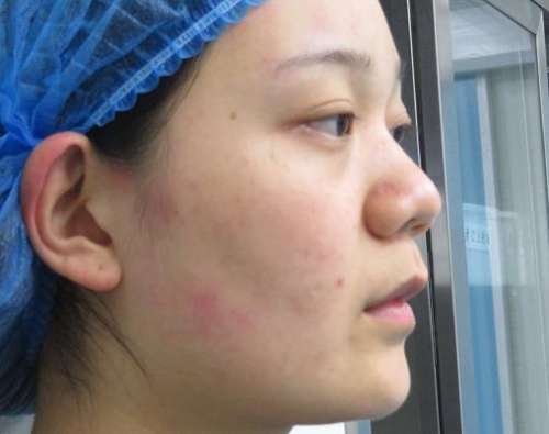 南京军区医院崔磊医生鼻整形案例分析插图1 南京军区医院崔磊医生鼻整形案例分析插图1