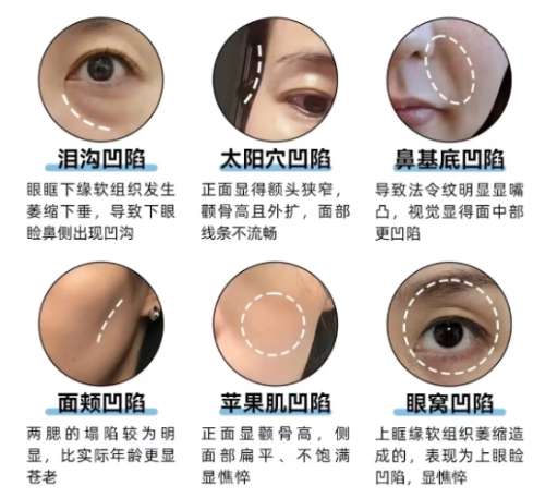 湘雅医院脂肪填充哪个医生好?范鹏举|杨兴华口碑不错插图4 湘雅医院脂肪填充哪个医生好?范鹏举|杨兴华口碑不错插图4