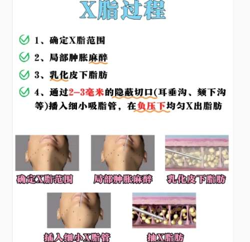 广州面吸医生技术厉害的三个医生!医生技术详细介绍插图4 广州面吸医生技术厉害的三个医生!医生技术详细介绍插图4