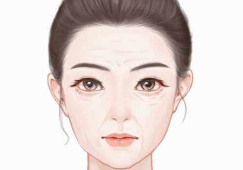 北京高亚东拉皮手术案例分析插图 北京高亚东拉皮手术案例分析插图