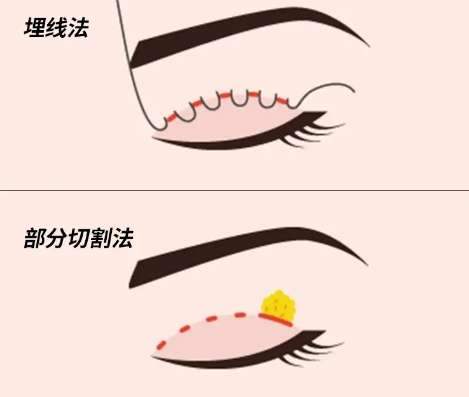 徐州双眼皮杨琳医生口碑怎么样?医生资料|坐诊医院简介|案例分析插图3 徐州双眼皮杨琳医生口碑怎么样?医生资料|坐诊医院简介|案例分析插图3
