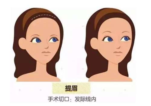 弓军胜和冯瑞珍哪个医生做眼部切眉提眉做的好？各有千秋，医生对比分享插图3