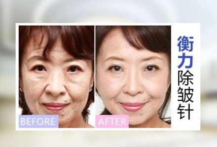 去皱纹的针有副作用吗？打完针后需要注意什么？插图