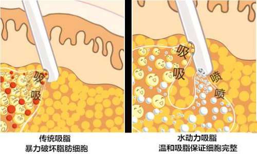钟伟洪吸脂技术怎么样？掌握多种吸脂方式、损伤小、价格动人、审美好…插图2