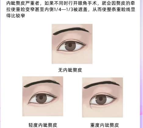 沈阳双眼皮牛的医生是谁?医生口碑比较好名单更新!插图4 沈阳双眼皮牛的医生是谁?医生口碑比较好名单更新!插图4