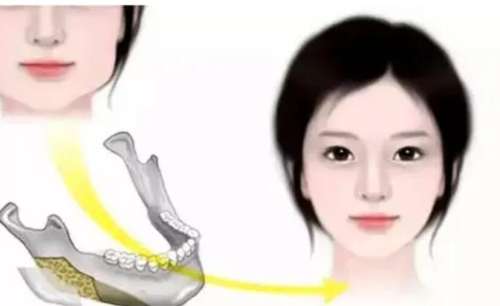 北京圣嘉荣黄大勇下颌角手术好吗？真人磨骨案例分析插图1