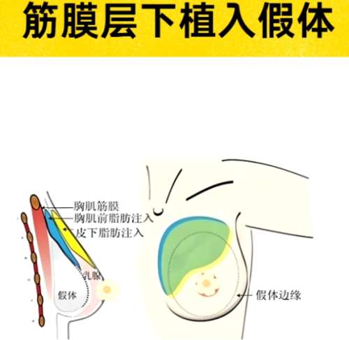 宁波假体隆胸比较厉害的医生!妥妥的实力派隆胸大咖!插图4 宁波假体隆胸比较厉害的医生!妥妥的实力派隆胸大咖!插图4