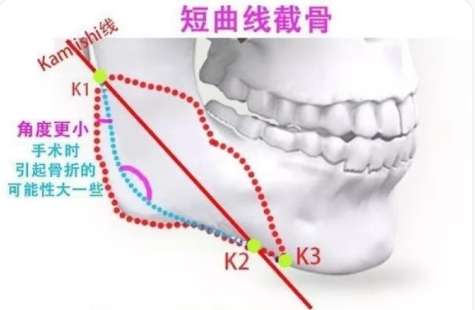 上海磨骨哪个医生好?医生排名名单揭秘!附坐诊医院插图4 上海磨骨哪个医生好?医生排名名单揭秘!附坐诊医院插图4
