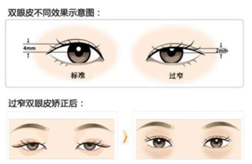 北京双眼皮修复李发成医生口碑怎么样？北京三甲医院专家实力测评！插图2