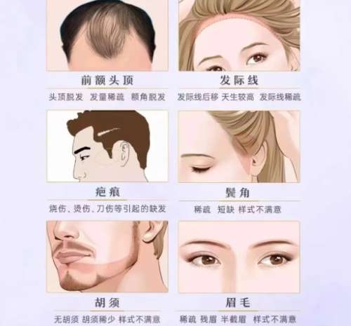 胡志奇植发多少钱?做的好吗?附客户真实点评插图1 胡志奇植发多少钱?做的好吗?附客户真实点评插图1