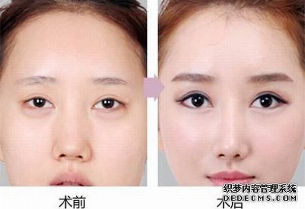 双眼皮手术修复术失败会怎么样？效果好吗？多少钱？插图1