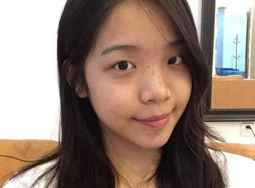 石家庄雅芳亚刘冰阳眼综合案例分析插图1 石家庄雅芳亚刘冰阳眼综合案例分析插图1