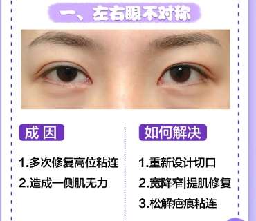 长春双眼皮修复好的医生都有谁?刘海鹏、李腾海通通上榜!插图4 长春双眼皮修复好的医生都有谁?刘海鹏、李腾海通通上榜!插图4