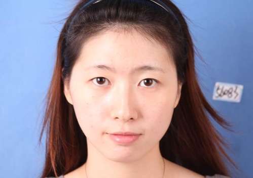 南京二院刘宁双眼皮案例分析插图1 南京二院刘宁双眼皮案例分析插图1