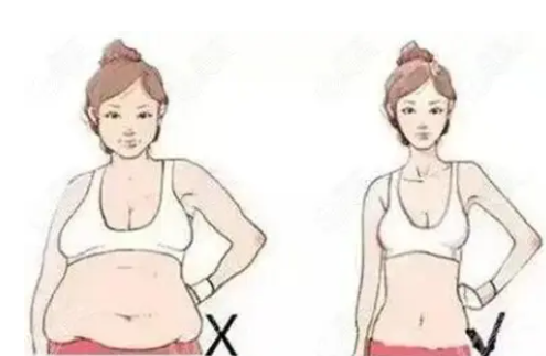 腹部抽脂让游泳圈快速消失插图 腹部抽脂让游泳圈快速消失插图