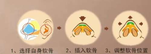 上海九院刘凯医生口碑怎么样?擅长的项目有哪些?鼻部实例插图4 上海九院刘凯医生口碑怎么样?擅长的项目有哪些?鼻部实例插图4