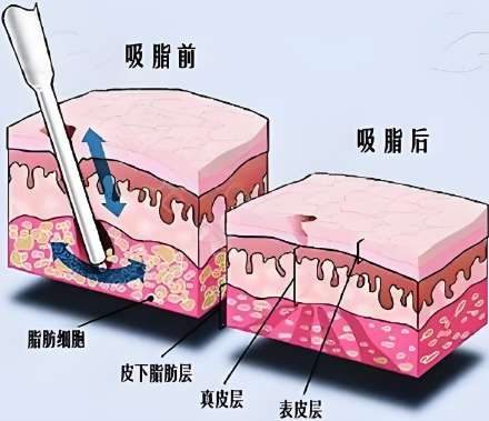 嘉兴吸脂做得比较好的医生哪个比较好?五位 “脂肪塑形大师” 的瘦身技巧分享插图 嘉兴吸脂做得比较好的医生哪个比较好?五位 “脂肪塑形大师” 的瘦身技巧分享插图
