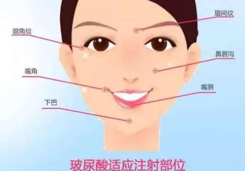 北京张昭玻尿酸怎么样？26年价格表及科普知识更新！插图2