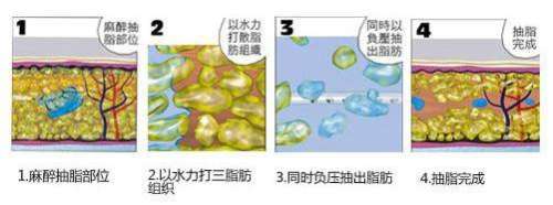 陈文才医生吸脂手术怎么样?医生技术测评,面吸6800元起插图1 陈文才医生吸脂手术怎么样?医生技术测评,面吸6800元起插图1