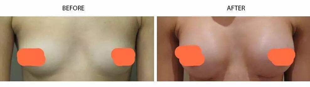 胸部无痕隆乳术——超完美的隆胸方法插图3